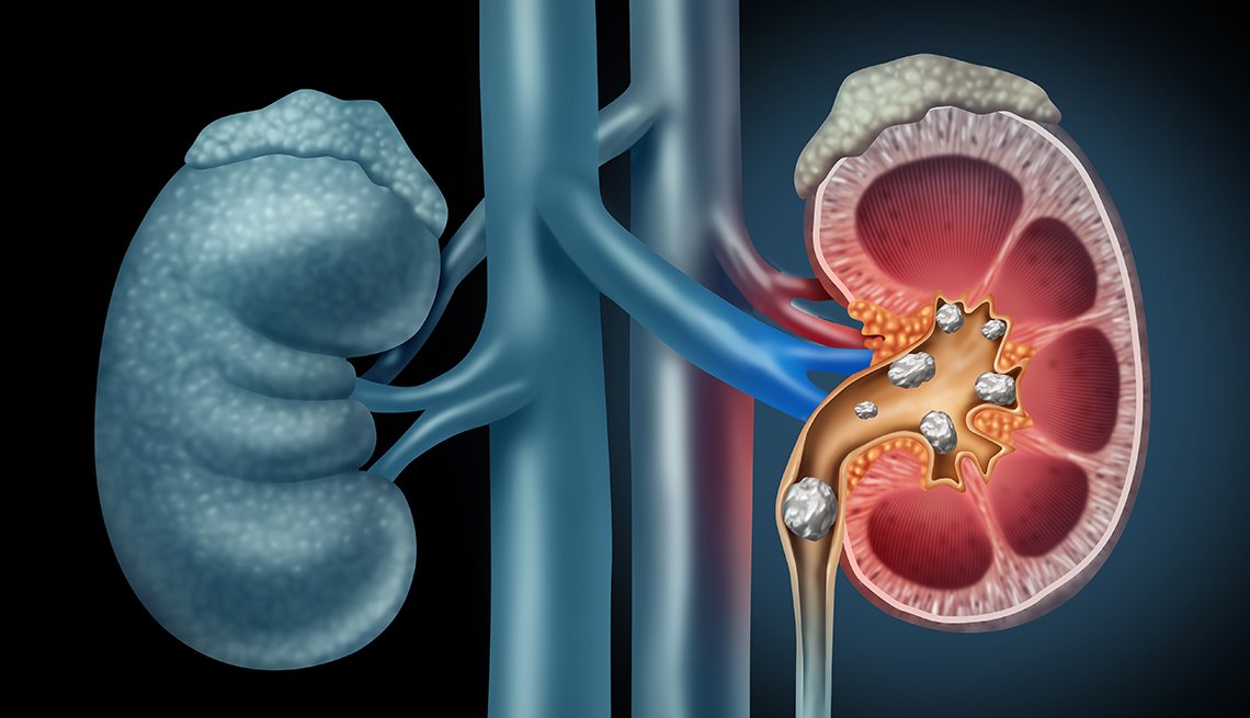 Epidemiología de los cálculos de las vías urinarias