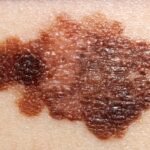 ¿Cuáles son los factores de riesgo para desarrollar Melanoma Cutáneo?
