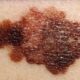 ¿Cuáles son los factores de riesgo para desarrollar Melanoma Cutáneo?
