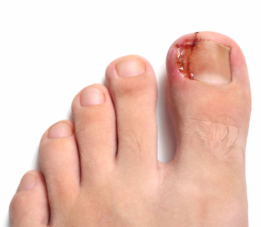 ¿Qué es la onicocriptosis?