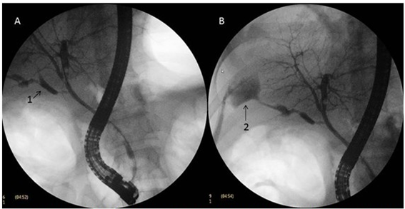 ¿Qué es la fuga biliar?