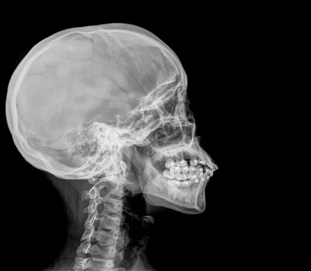 ¿Qué es la calota?