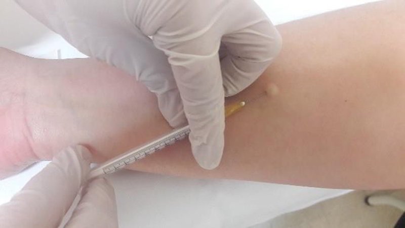 ¿Cómo se interpreta la prueba cutánea de tuberculina?