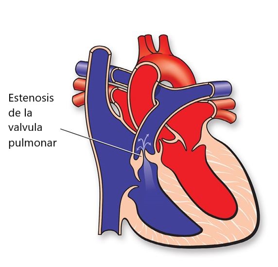 ¿Qué es la estenosis de la válvula pulmonar?