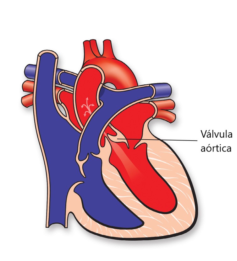 ¿Qué es la insuficiencia aórtica?