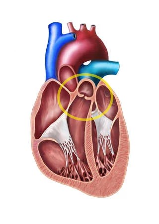 ¿Qué es la insuficiencia de la válvula pulmonar?