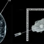 Biopsia de mama guiada por mamografía