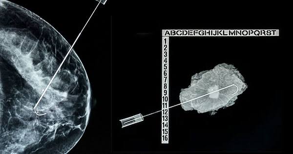 Biopsia de mama guiada por mamografía