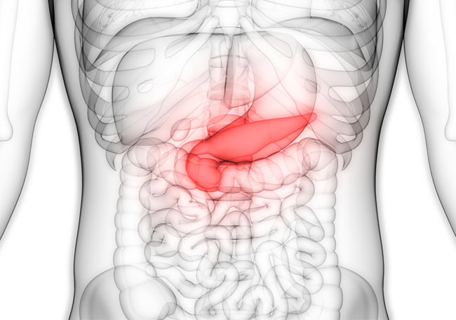 ¿Cómo se clasifica la pancreatitis aguda?