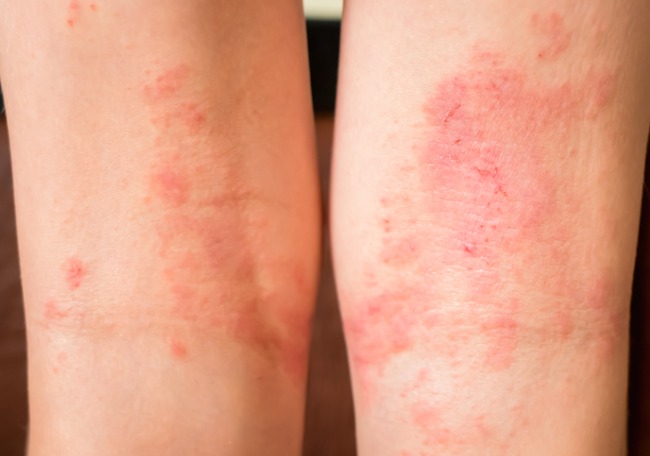 ¿Qué es la dermatitis atópica?