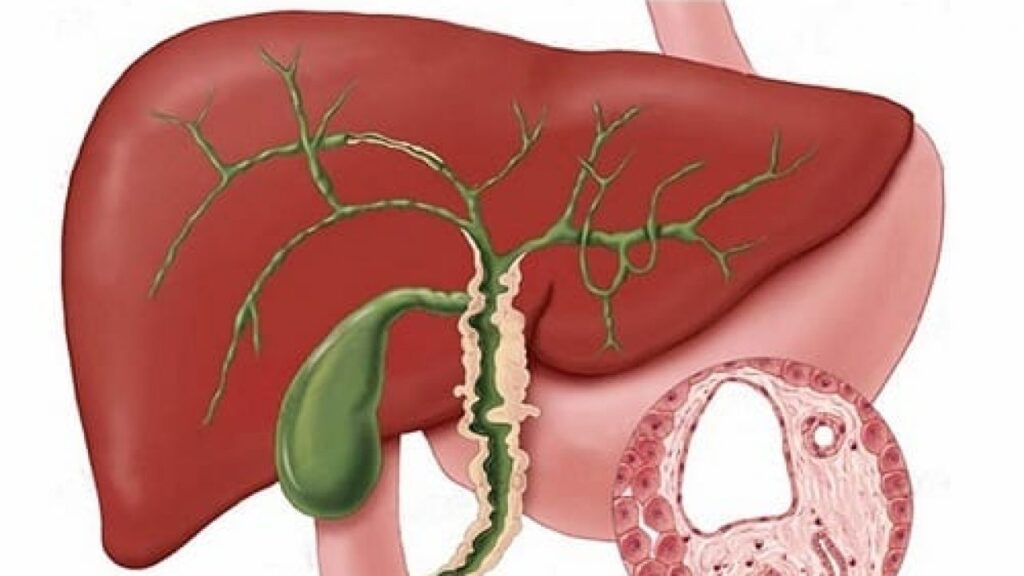 Colangitis esclerosante primaria