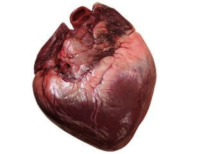 ¿Qué es la Miocardiopatía dilatada?