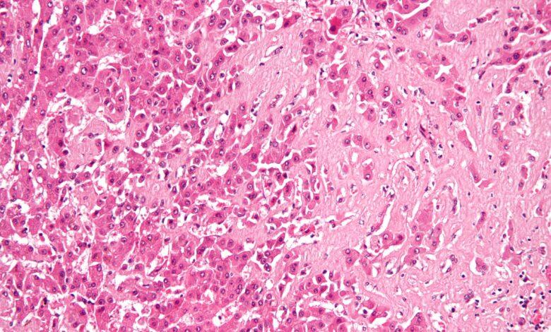 ¿Qué es la amiloidosis?