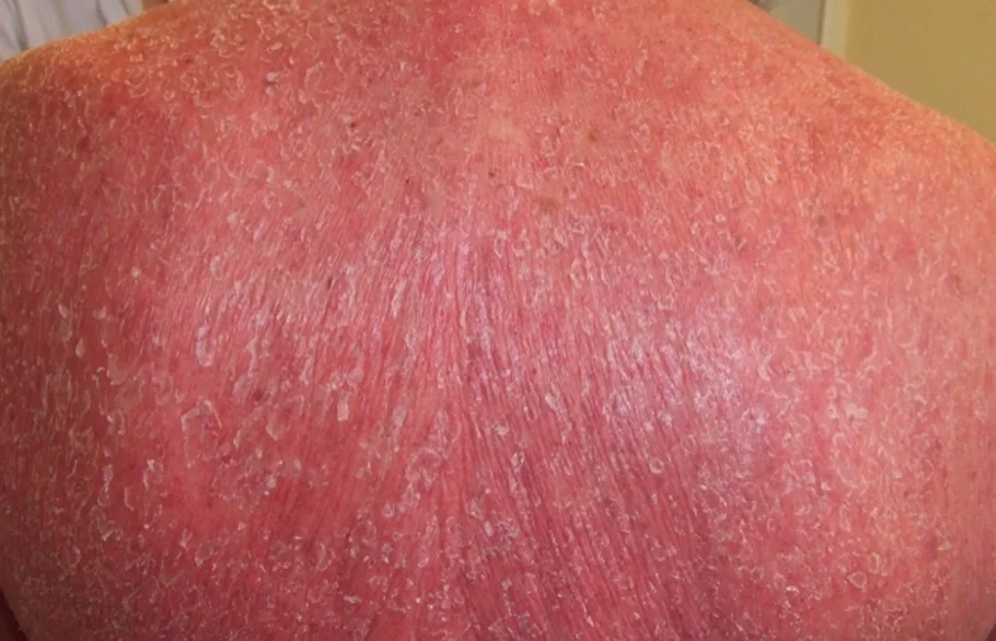 ¿Qué son las eritrodermias?