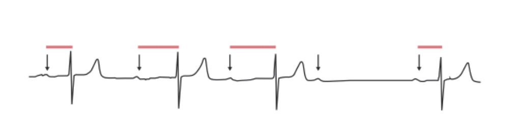 ¿Cómo se clasifica el bloqueo auriculo-ventricular?