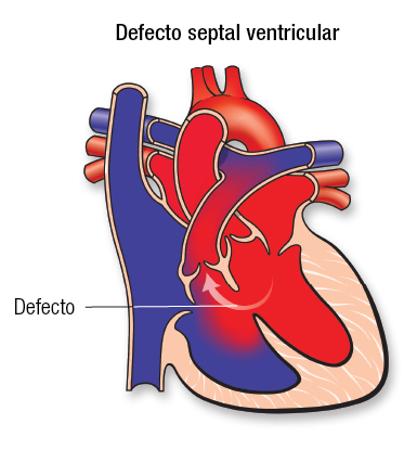 ¿Qué es la comunicación interventricular congénita?