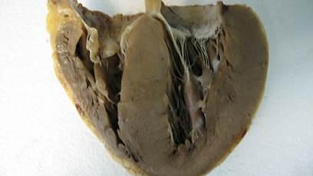 ¿Qué es la Miocardiopatía restrictiva?