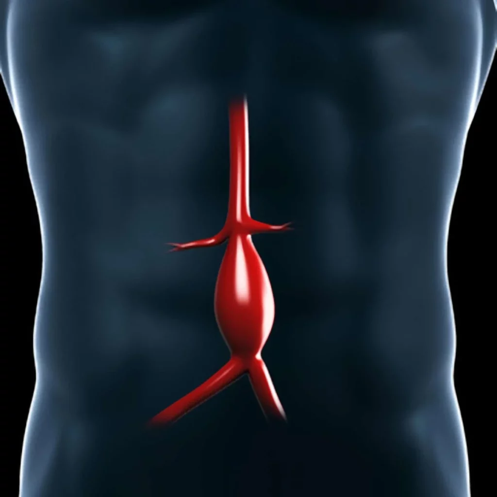 ¿Cuáles son las causas de aneurisma aórtico?