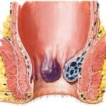 ¿Qué es la enfermedad hemorroidal?