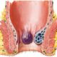 ¿Qué es la enfermedad hemorroidal?