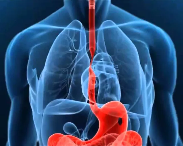 ¿Qué es la estenosis esofágica por reflujo?