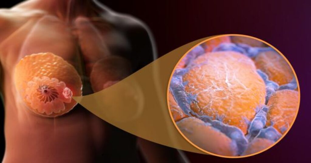 ¿Qué es el cáncer de mama invasor?