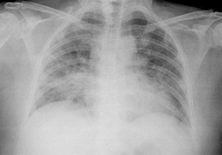 ¿Qué es la neumonitis por hipersensibilidad?