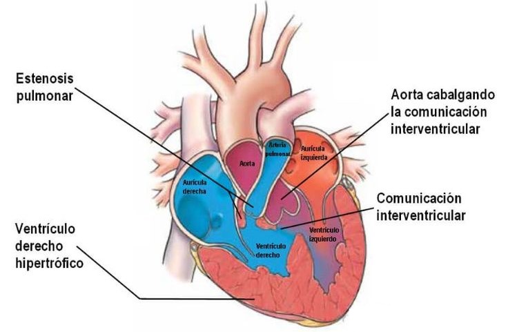 ¿Qué es la tetralogía de Fallot?