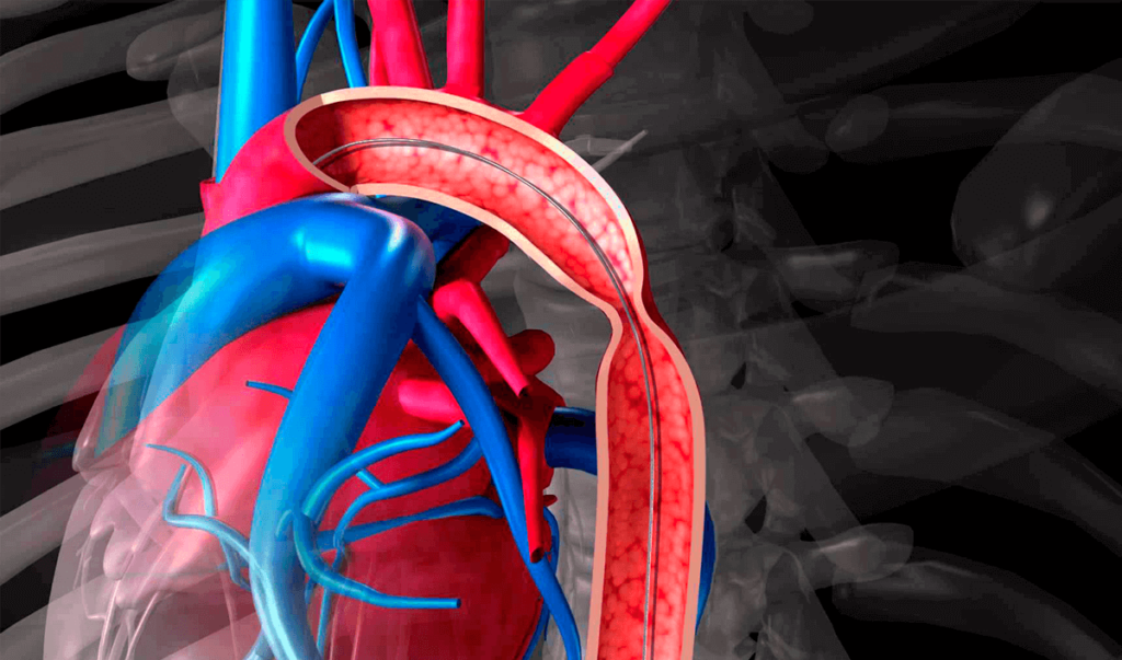 Repaso rápido: Coartación de la aorta