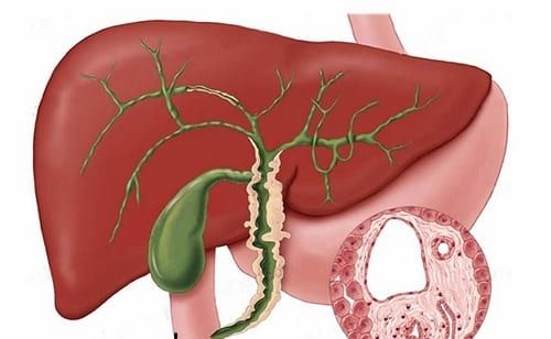 ¿Cuáles son las manifestaciones extrahepáticas de colangitis biliar primaria?