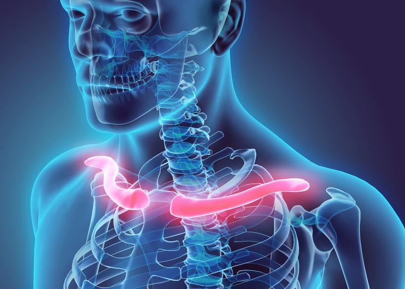 ¿Cómo se clasifican las fracturas de clavícula?