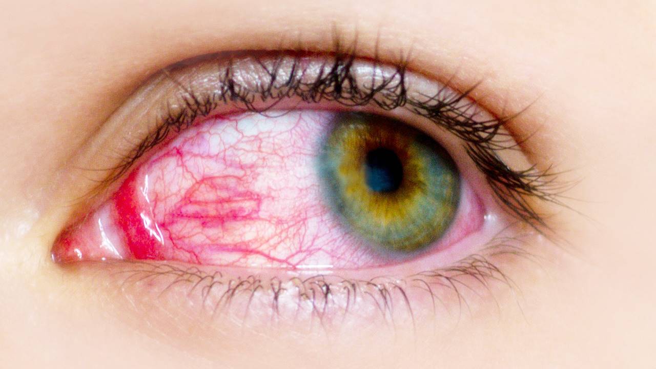 Conjuntivitis alérgica estacional y perenne