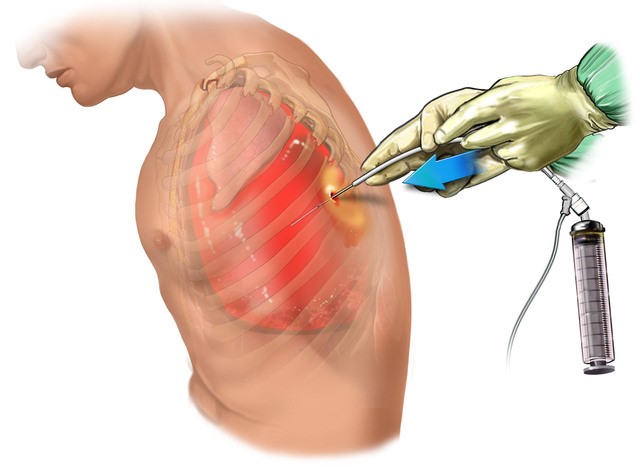 Toracocentesis y pleurotomía