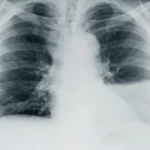 ¿Cuáles son los datos para el diagnóstico de derrame pleural?