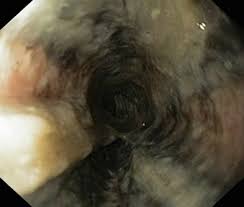 Necrosis esofágica aguda: “esófago negro”