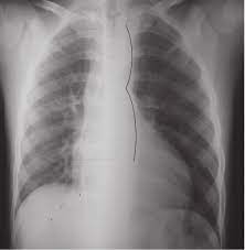 ¿Cuáles son las manifestaciones y el tratamiento de la coartación aórtica?