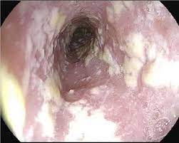 Candidiasis esofágica
