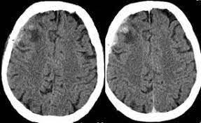 Hemorragia subaracnoidea