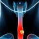 ¿Qué es el cáncer de esófago?