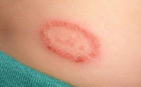 ¿Que es la tiña corporal?