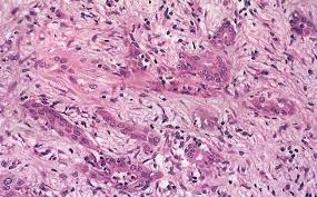 20 cosas que debes saber sobre el cáncer de páncreas.