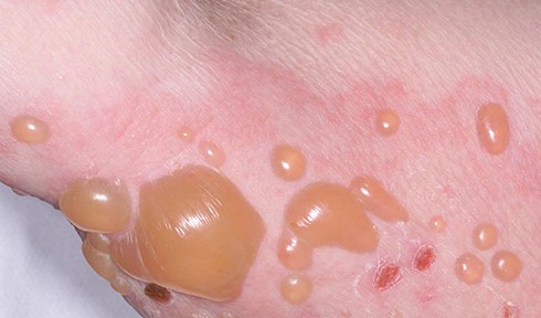 ¿Qué es el penfigoide?