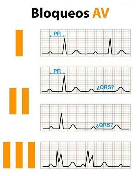 Defectos de la conducción cardiaca Auriculo – ventricular