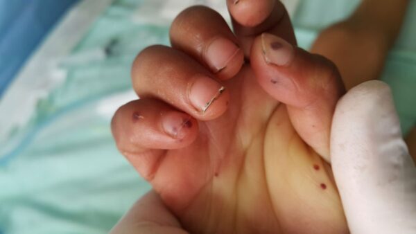 ¿Cuáles son las manifestaciones cutáneas de endocarditis infecciosa?