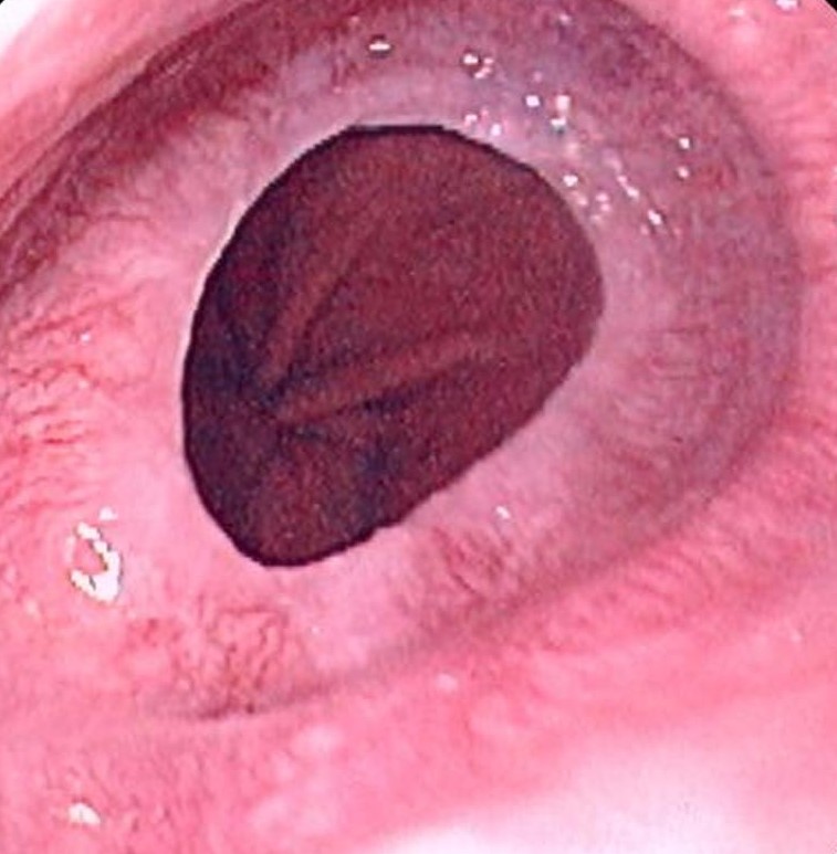 ¿Qué es el anillo de Schatzki?