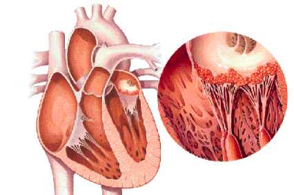 ¿Cómo afecta la fiebre reumática al corazón?