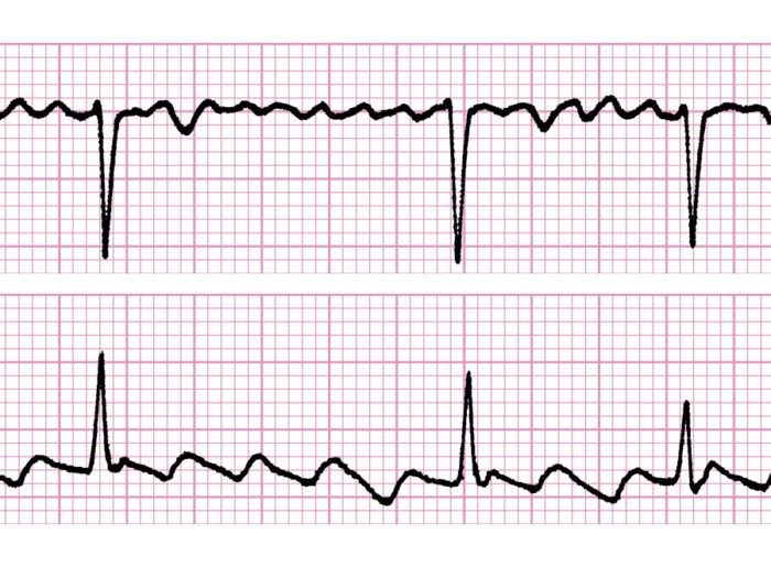 ¿Cómo se trata la fibrilación auricular?