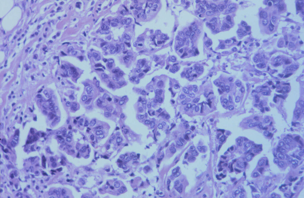 ¿Qué es el carcinoma micropapilar invasivo de mama?