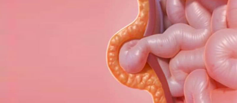 ¿Qué es la hernia umbilical?