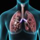 Clasificación de la Hipertensión Pulmonar